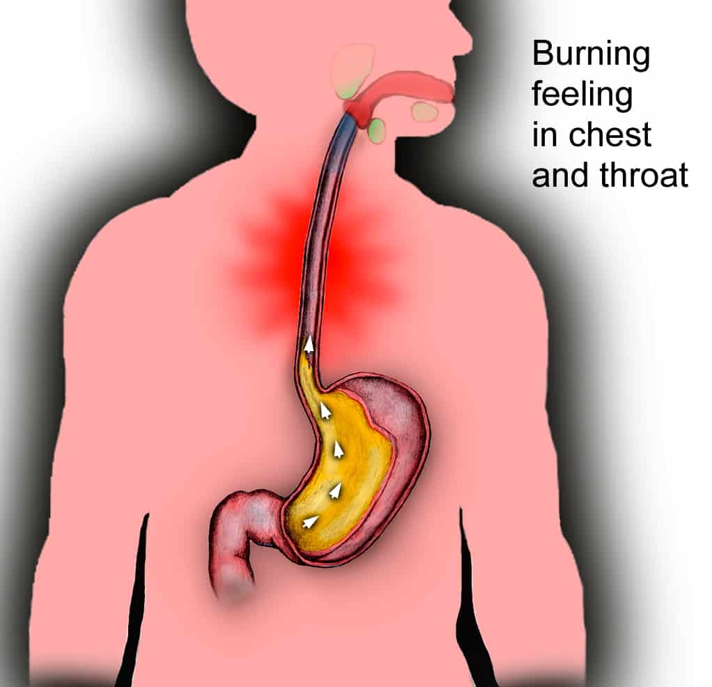 Acid Reflux
