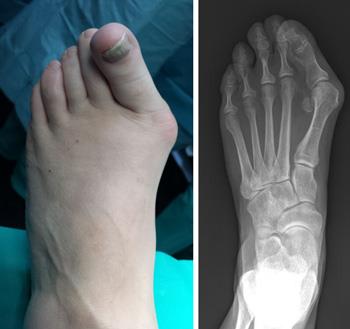 How to Ease Your Bunions without Surgery | 9 Natural ways to Cure!